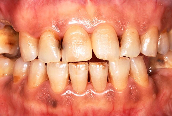 Mouth showing Early Carious Lesion