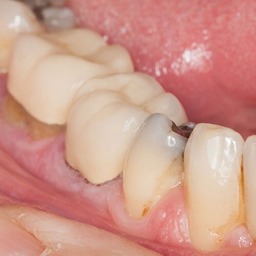 close-macro-shot-interior-mouth-fillings