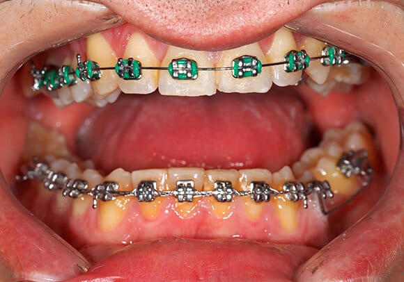 Close up of teeth with braces