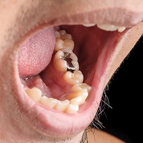 Mouth and teeth with amalgam restorations
