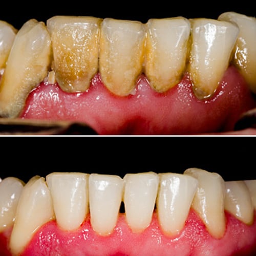 Generalized Loss Of Attachment And Gingival Recession