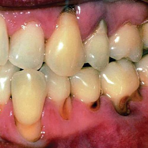 Localized Recession And Root Caries